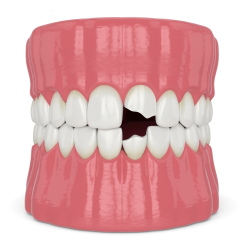 3d render of jaw with broken incisors teeth
